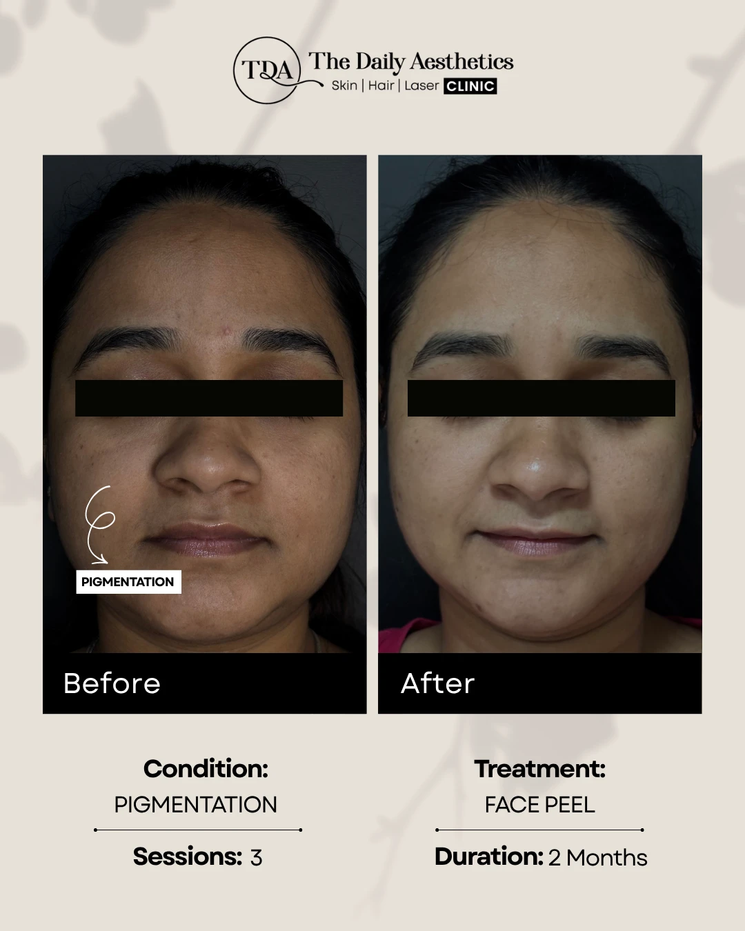 Pigmentation (Face Peel Treatment)