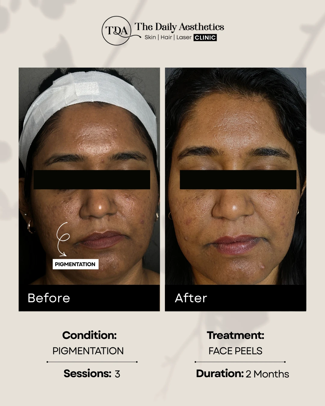 Pigmentation (Face Peels Treatment)