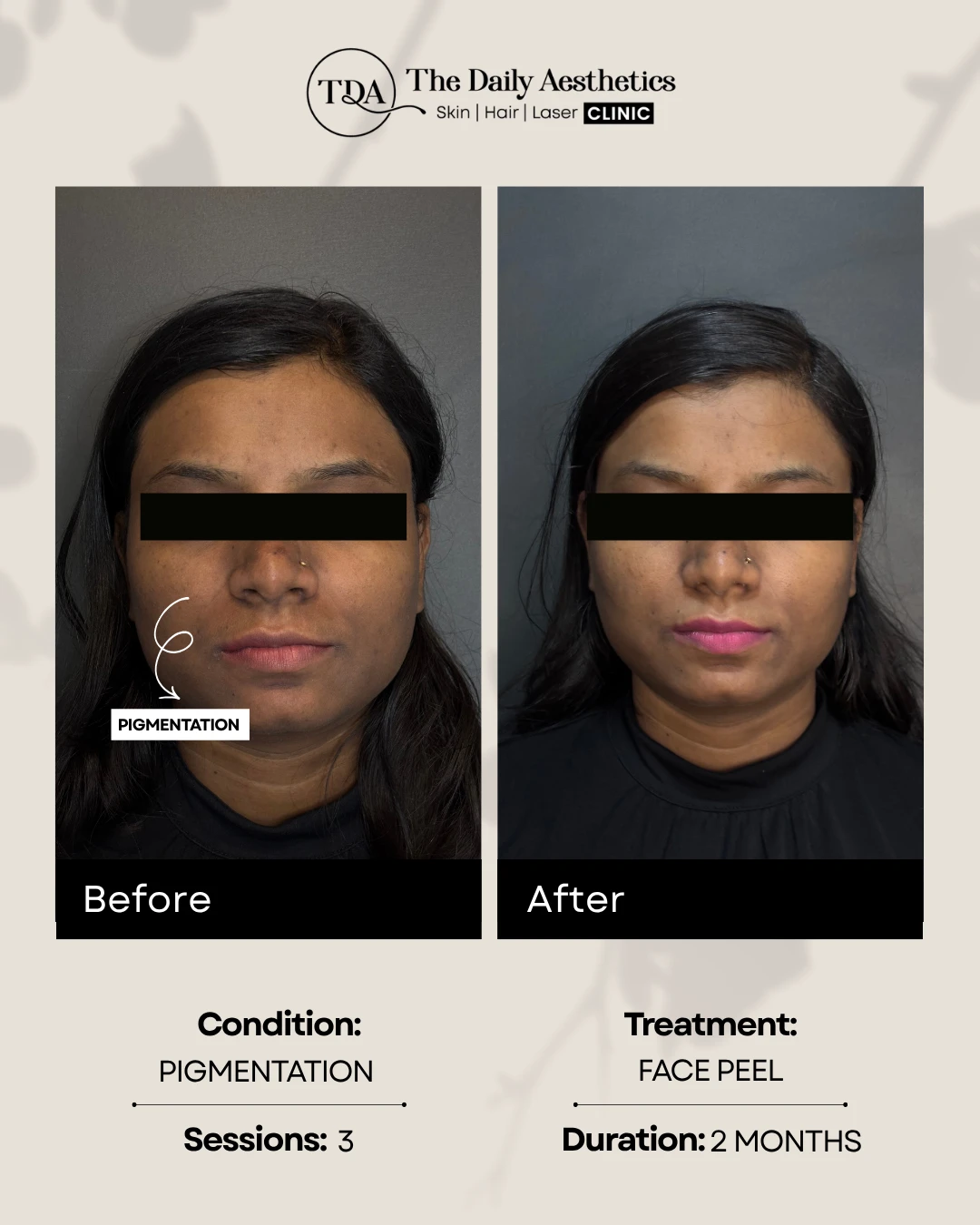 Pigmentation (FacePeel)