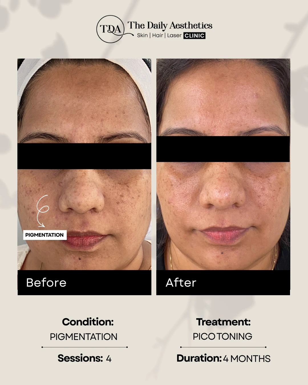 Pigmentation (Pico Toning) (2)