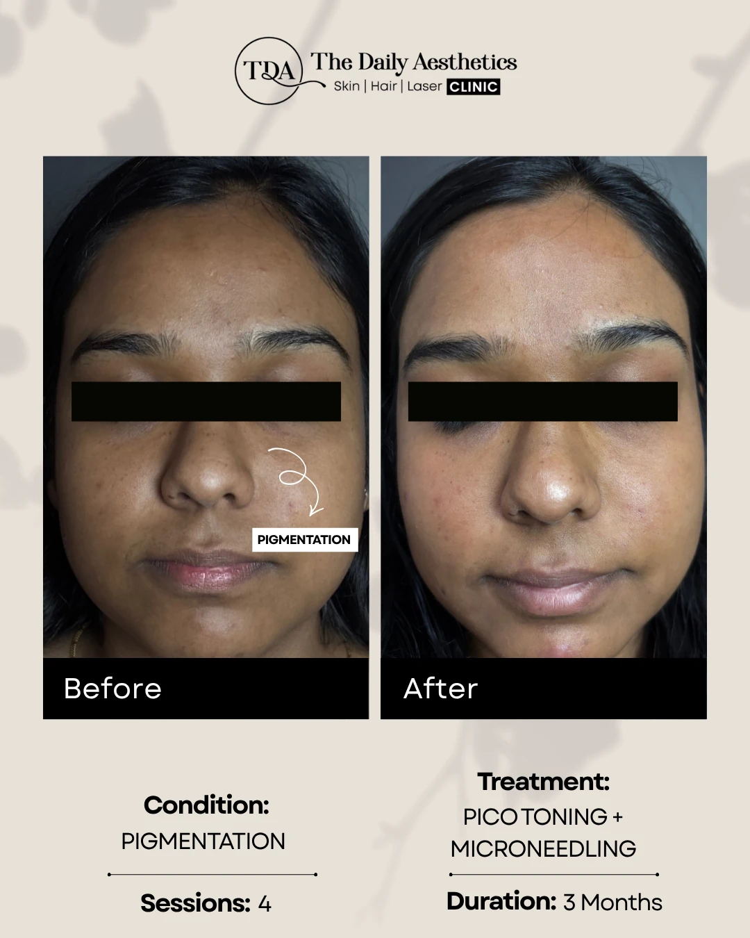 Pigmentation (Pico Toning + Microneedling Treatment)