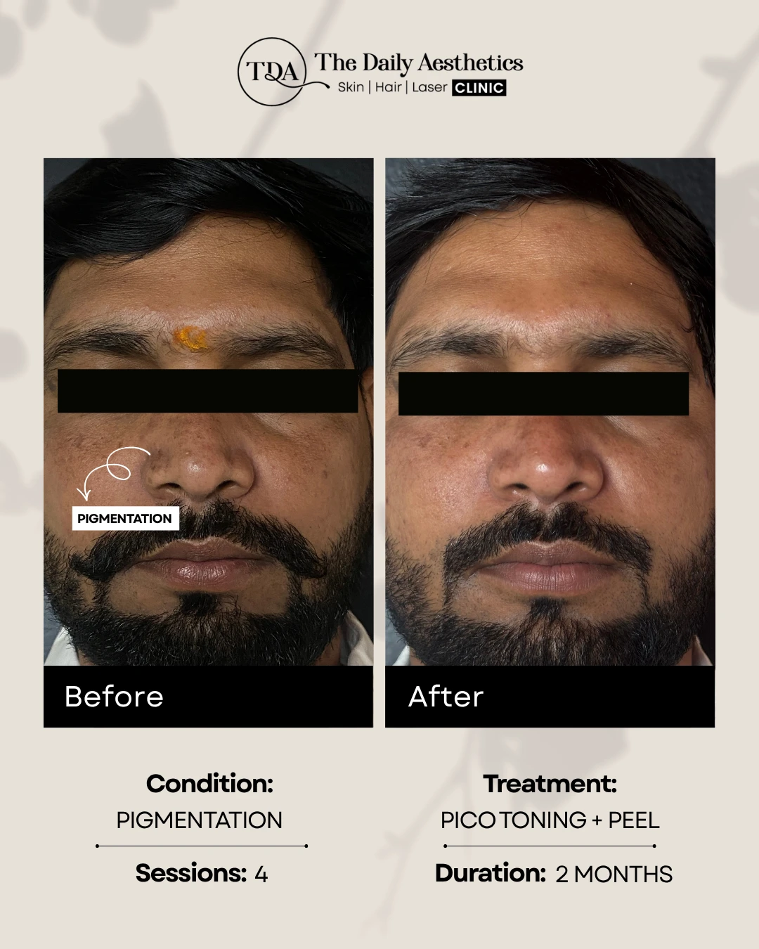 Pigmentation (Pico Toning + Peel Treatment) (2)