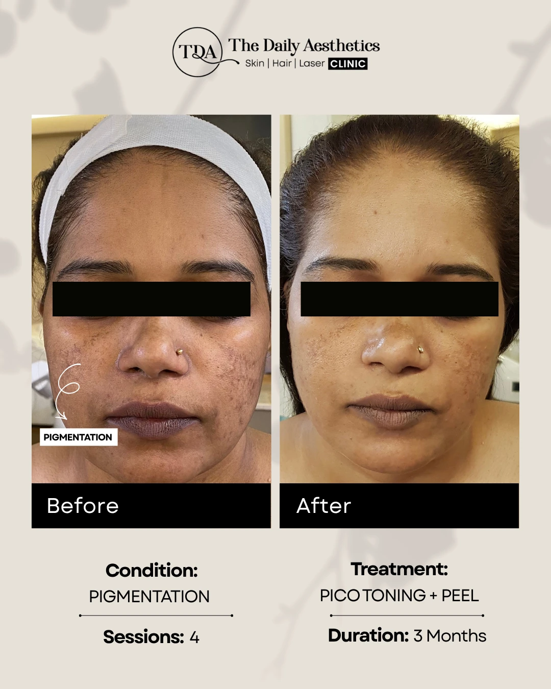 Pigmentation (Pico Toning + Peel Treatment)