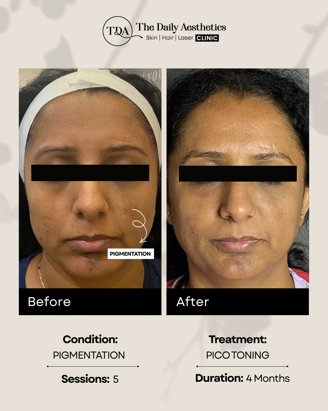 Pigmentation (Pico Toning Treatment)