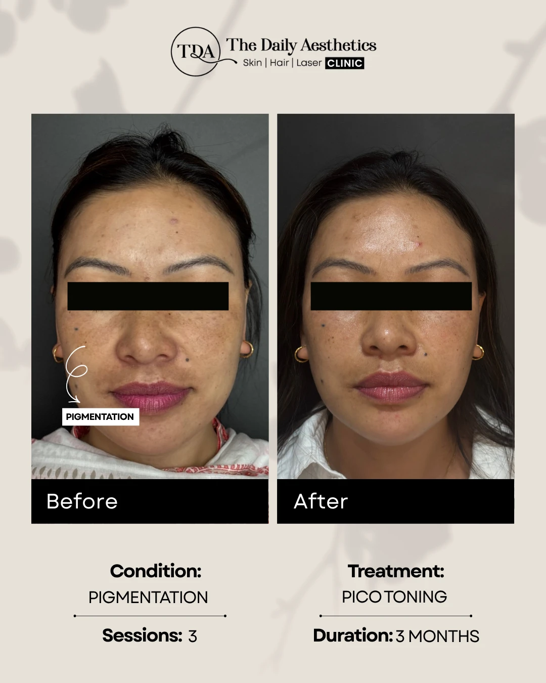 Pigmentation (Pico Toning)