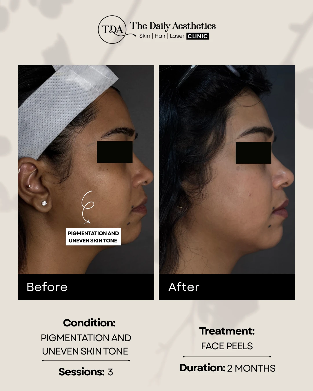 Pigmentation and Uneven Skintone (Face Peel Treatment)
