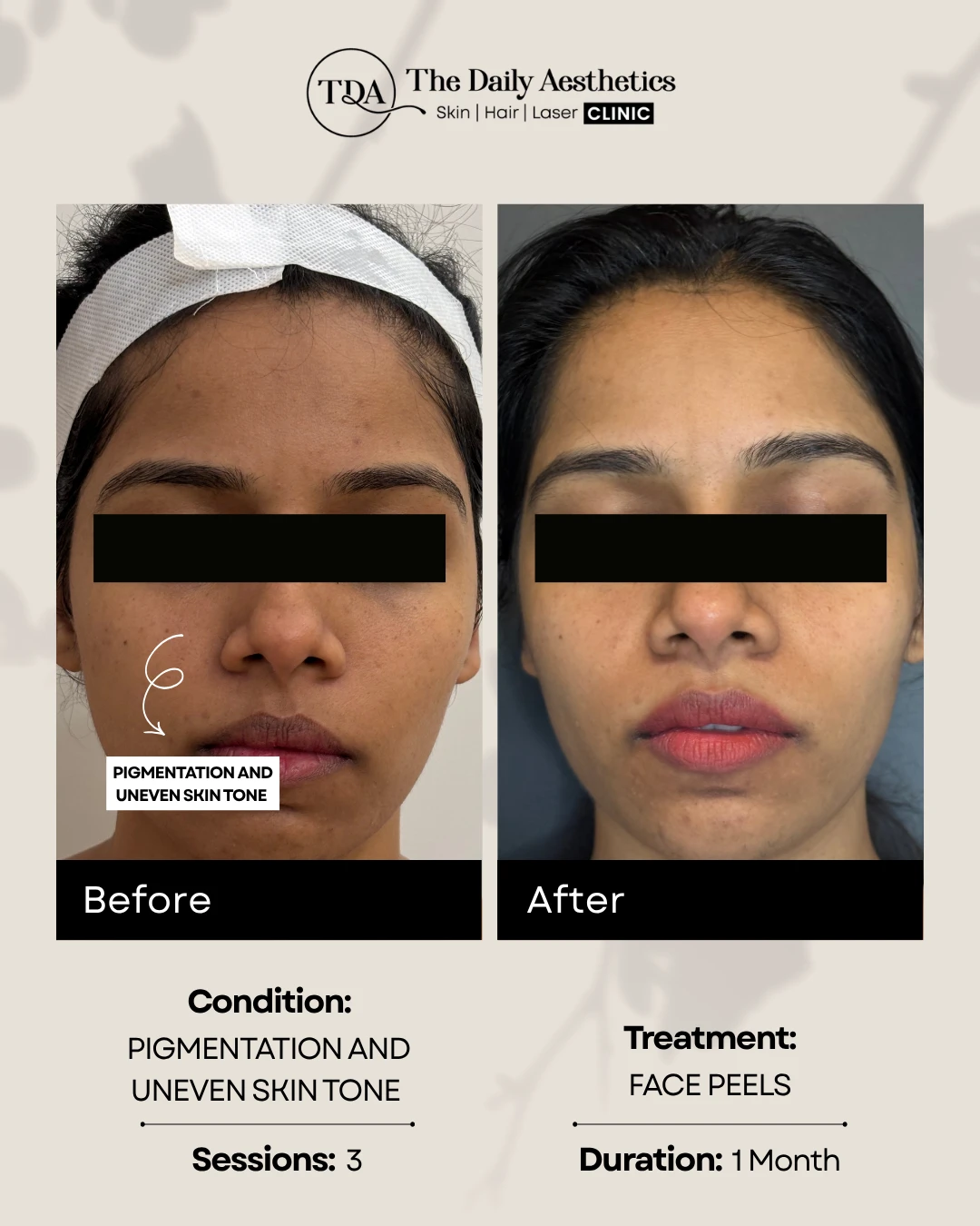 Pigmentation and Uneven Skintone (Face Peels Treatment)
