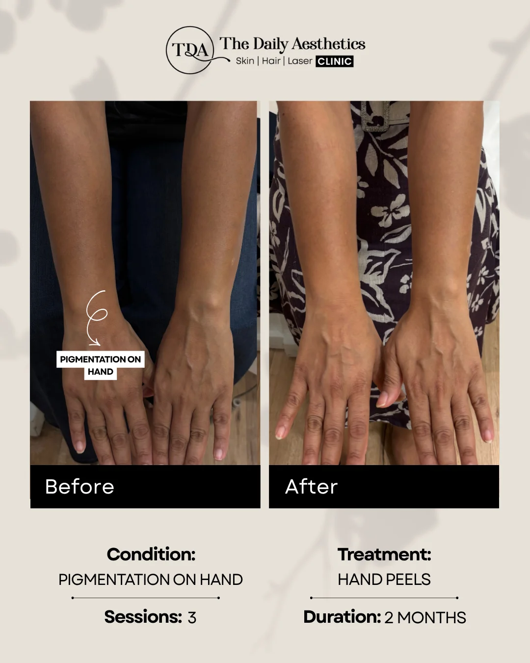 Pigmentation on Hand (Hand Peels)