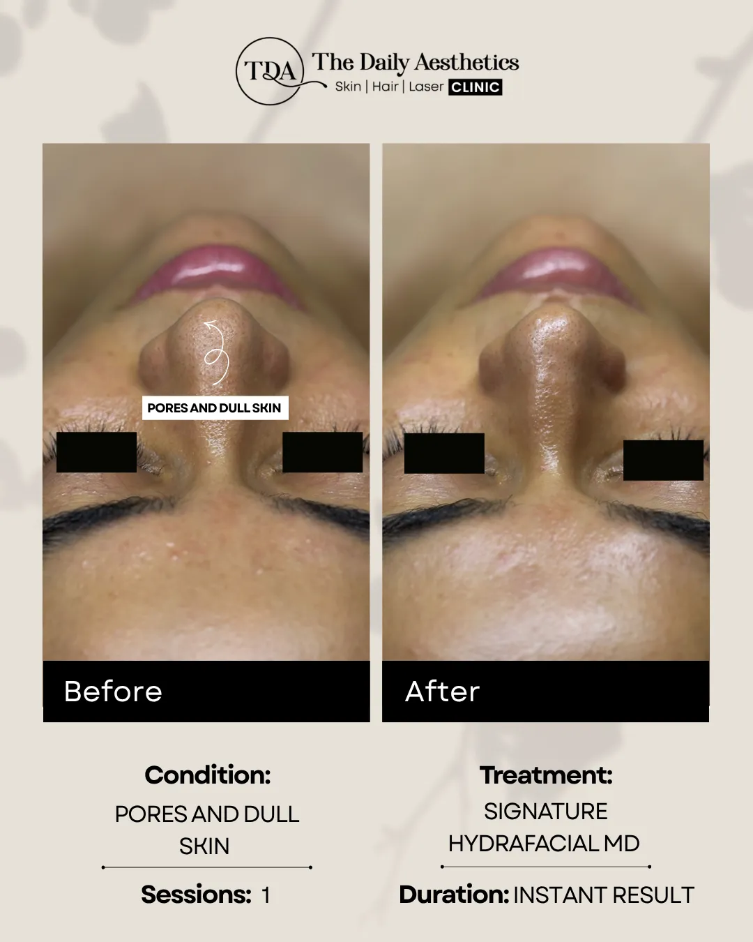 Pores And Dull Skin (Signature Hydrafacial MD Treatment)