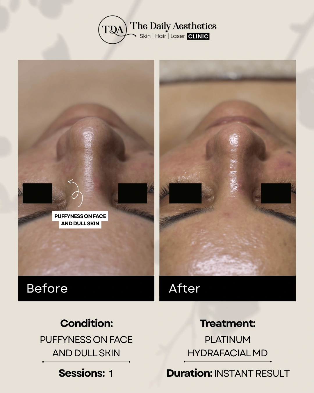 Puffyness On Face And Dull Skin (Platinum Hydrafacial MD Treatment)