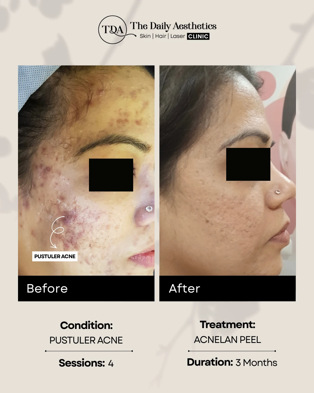 Pustuler Acne (Acnelean Peel Treatment)