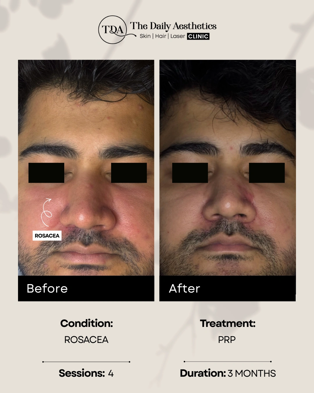 Rosacea (PRP Treatment)
