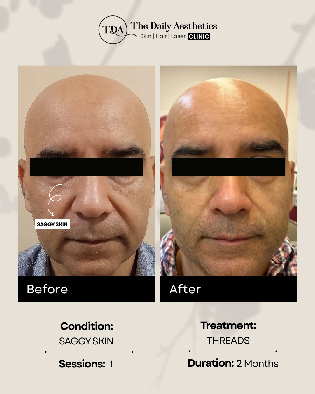 Saggy Skin (Threads Treatment)