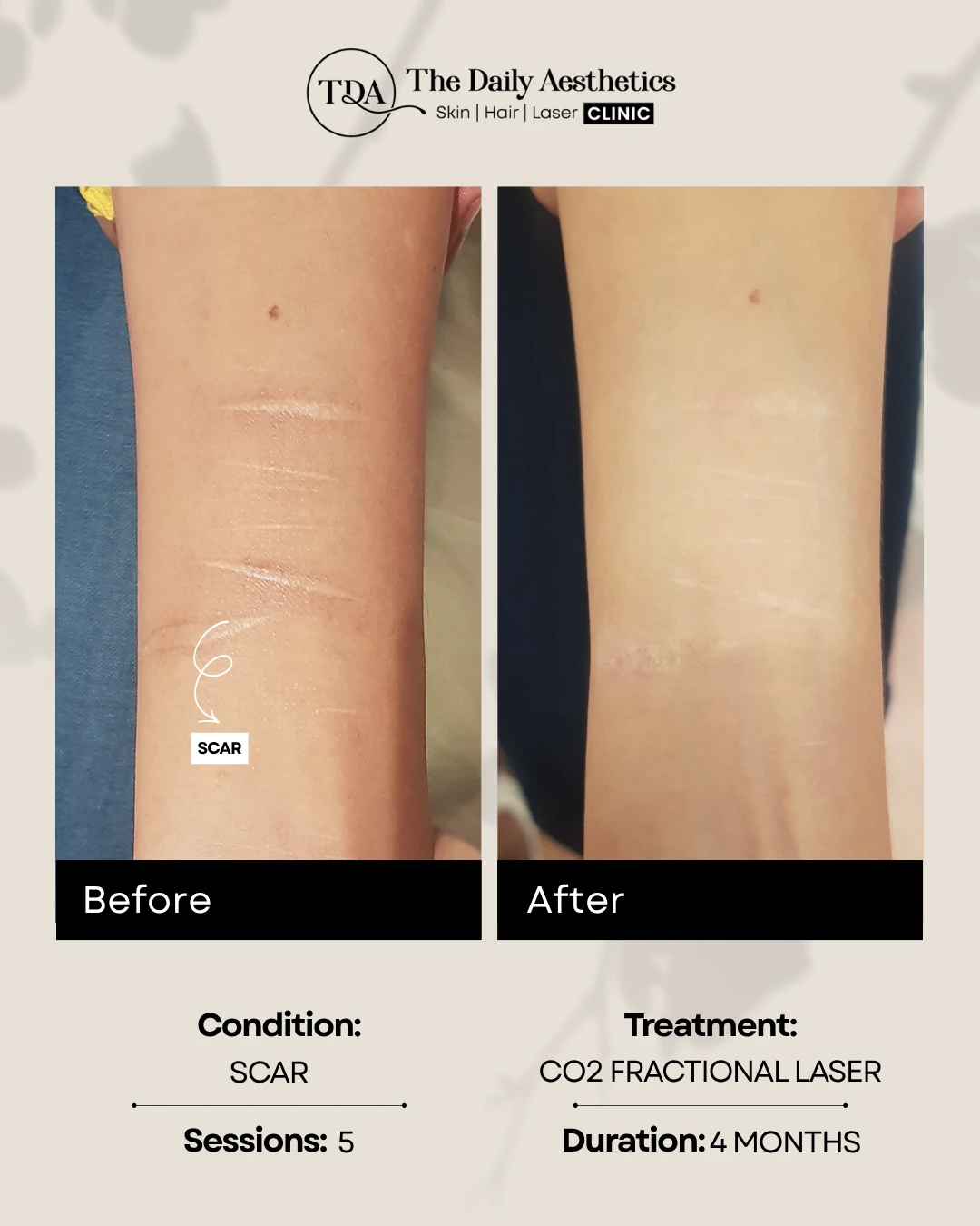 Scar (CO2 Fractional Laser)