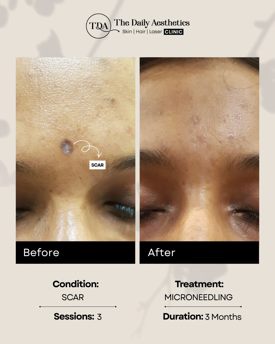 Scar (Microneedling Treatment)