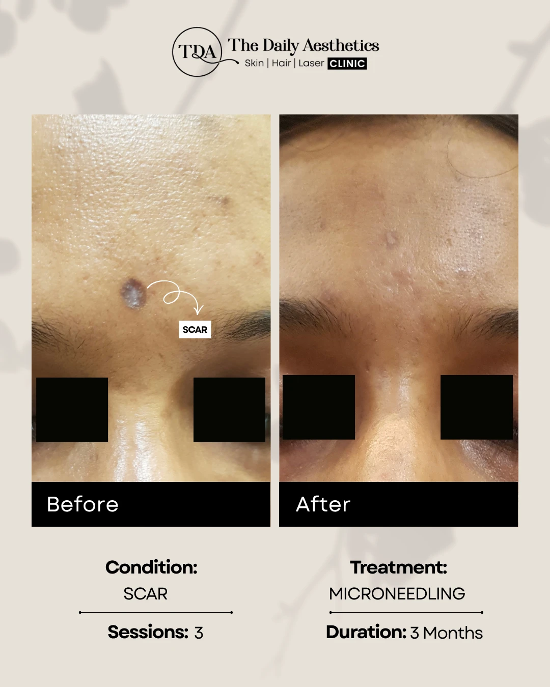 Scar (Microneedling)