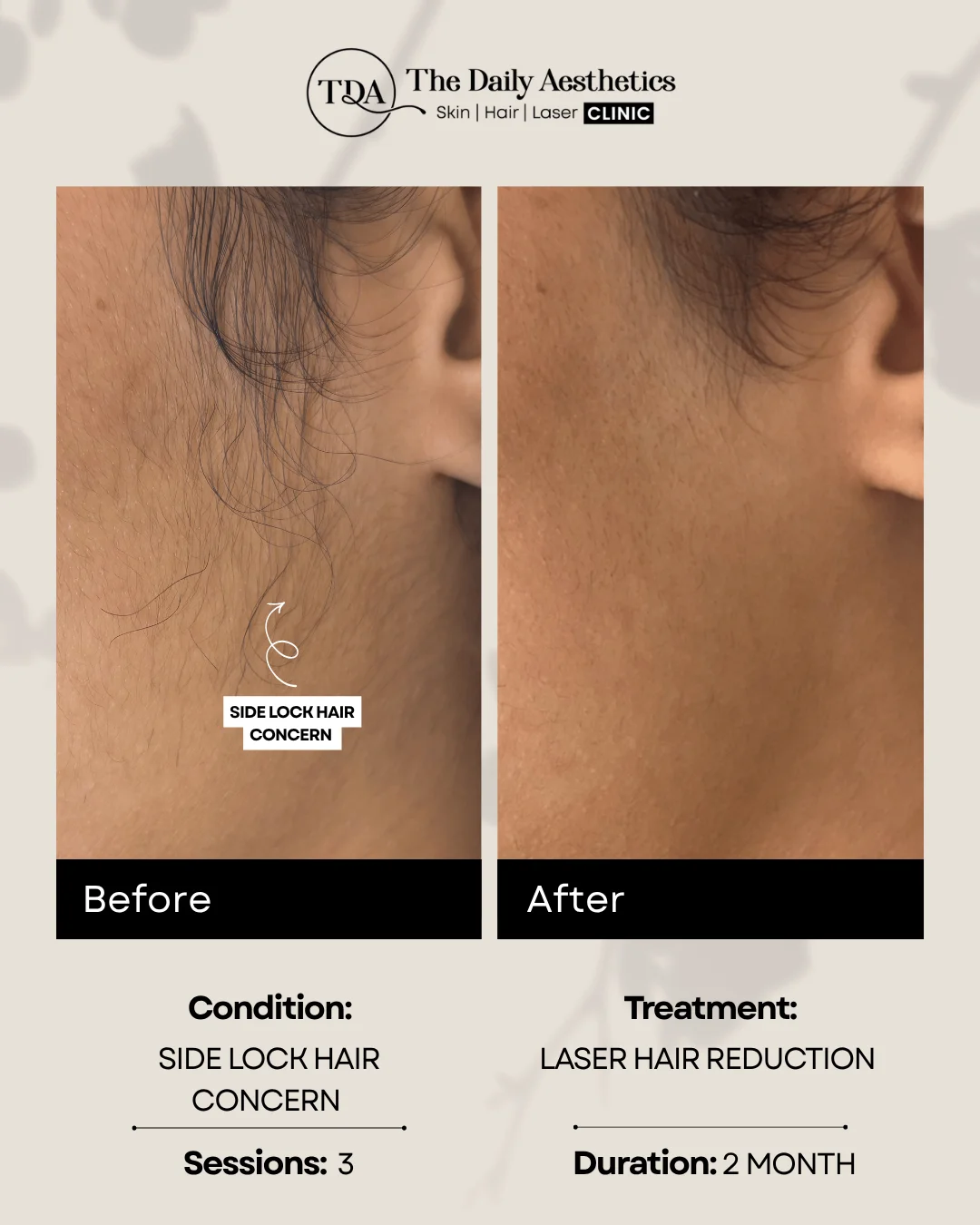 Side Lock Hair Concern (Laser Hair Reduction Treatment)