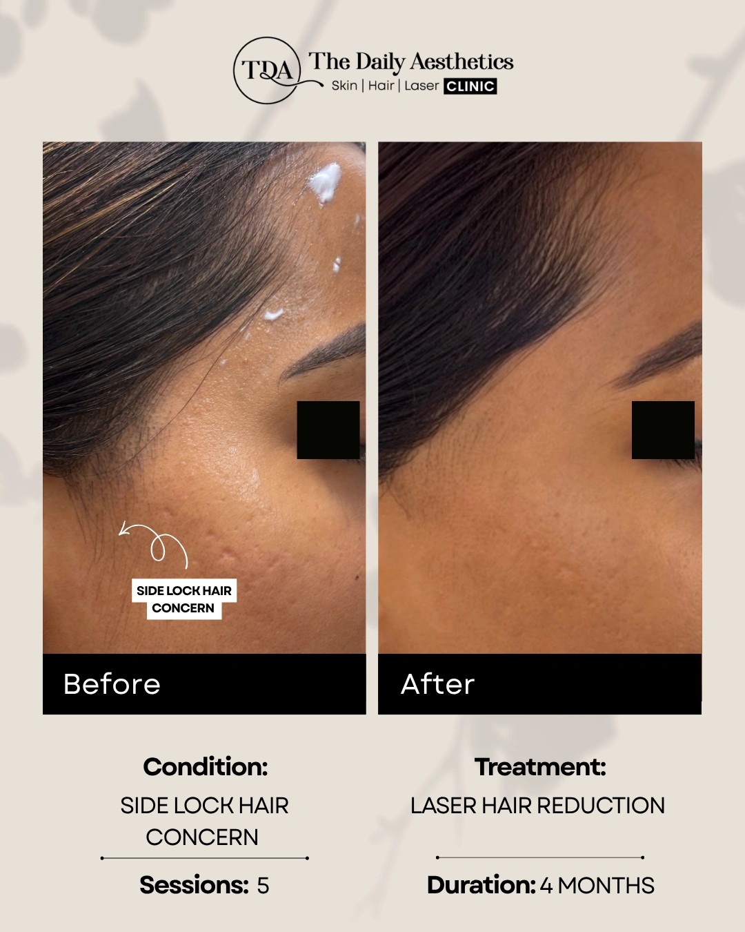 Side Lock Hair Concern (Laser Hair Reduction Treatment)
