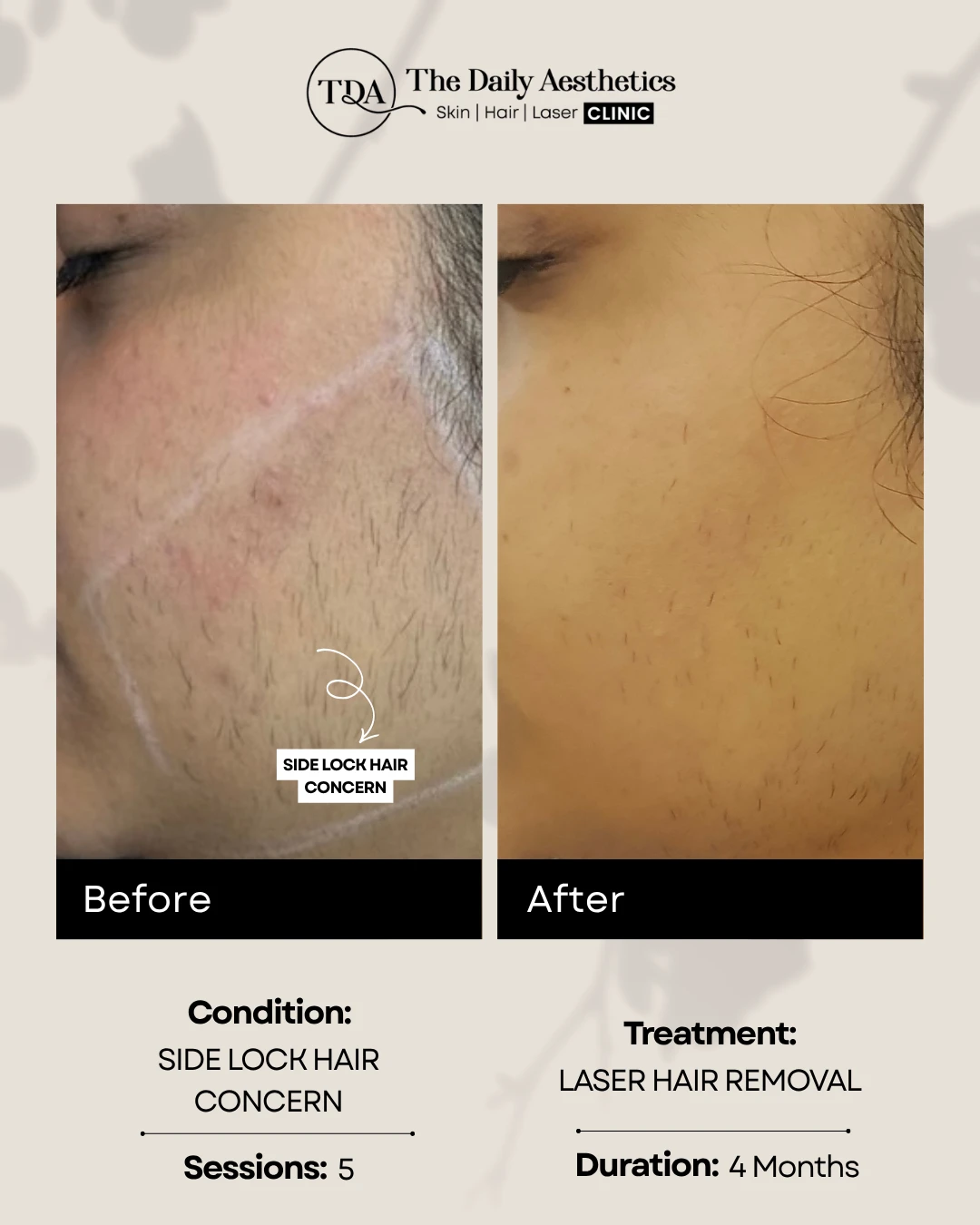 Side Lock Hair Concern (Laser Hair Removal Treatment)