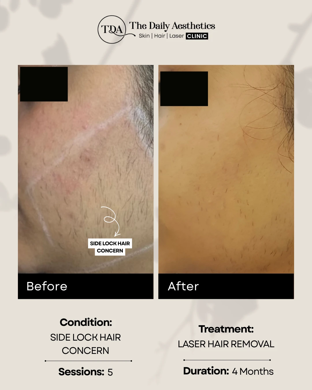 Side Lock Hair Concern (Laser Hair Removal)