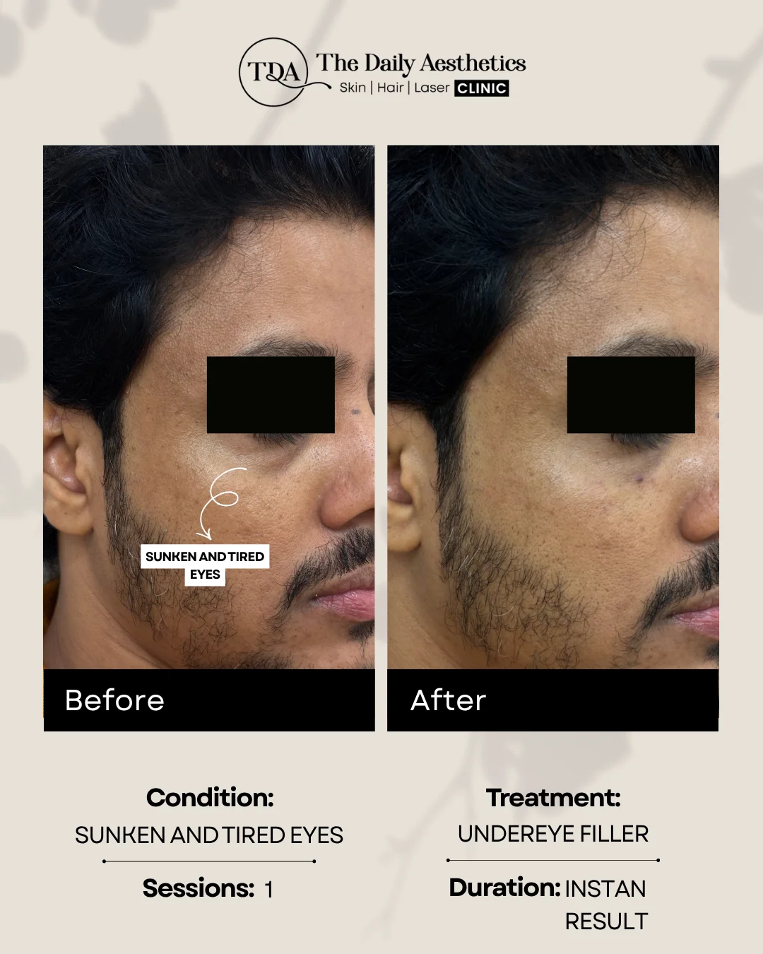 Sunken and Tired Eyes (Under Eye Filler)