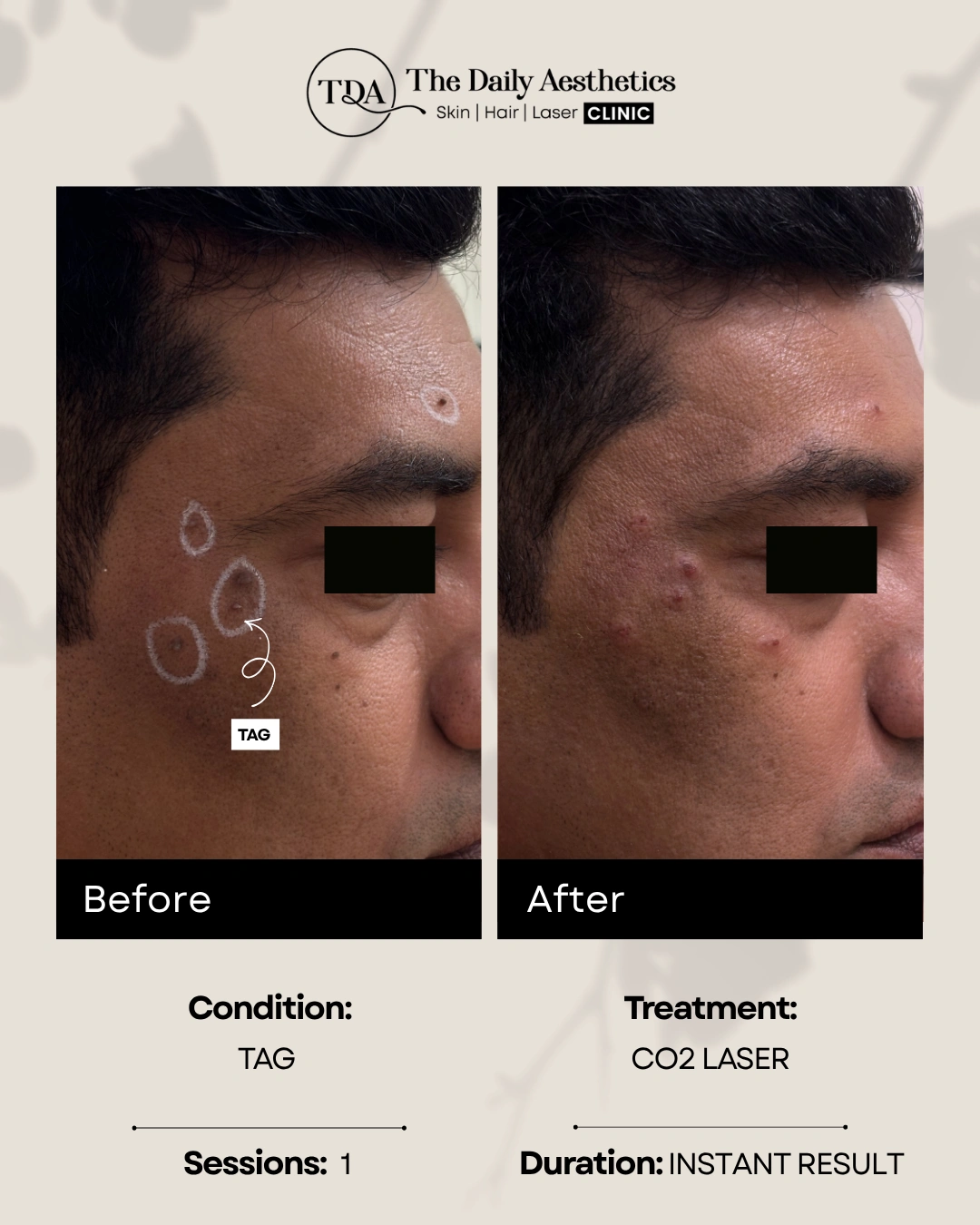 Tag (CO2 Laser Treatment) (2)