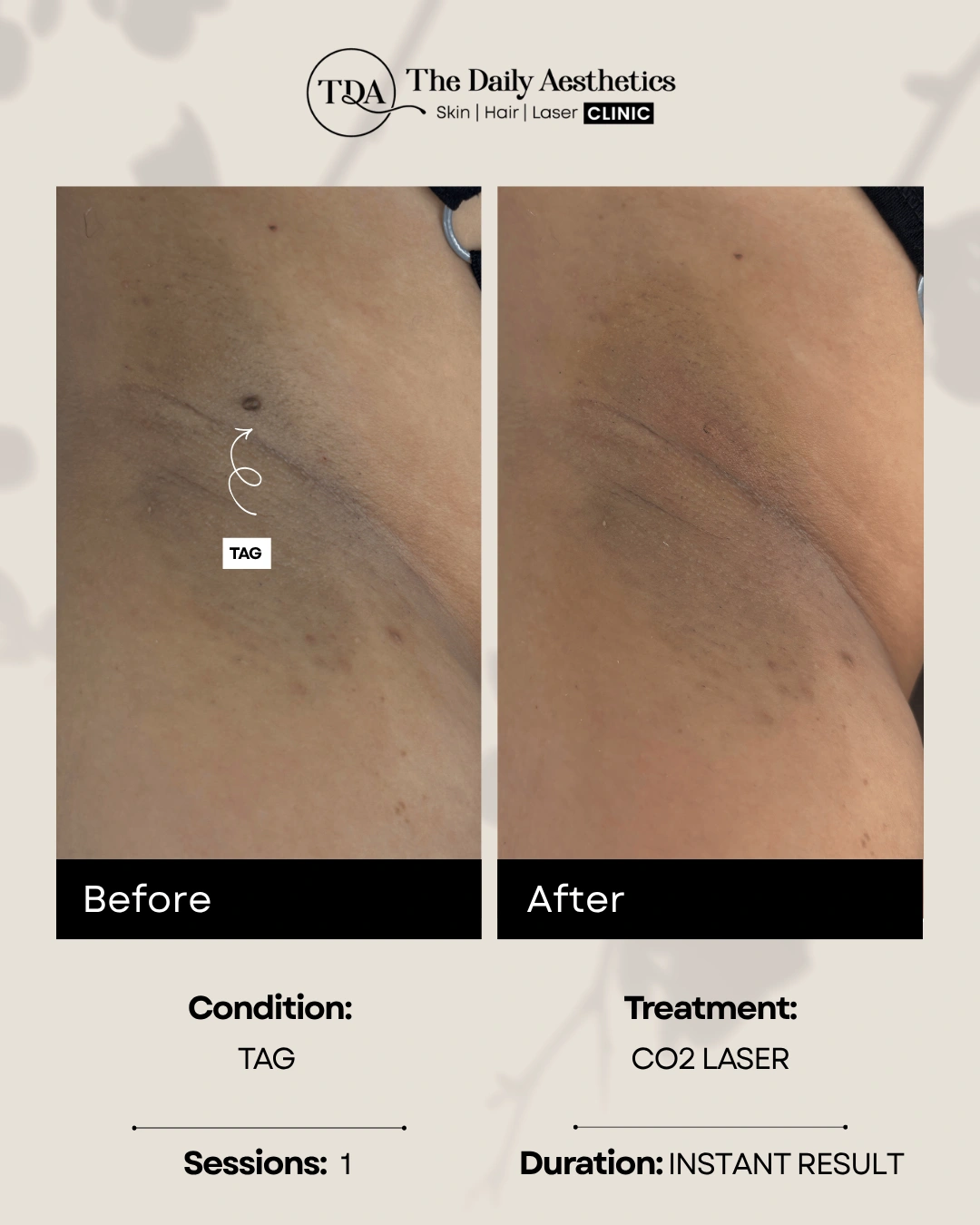 Tag (CO2 Laser Treatment) (3)