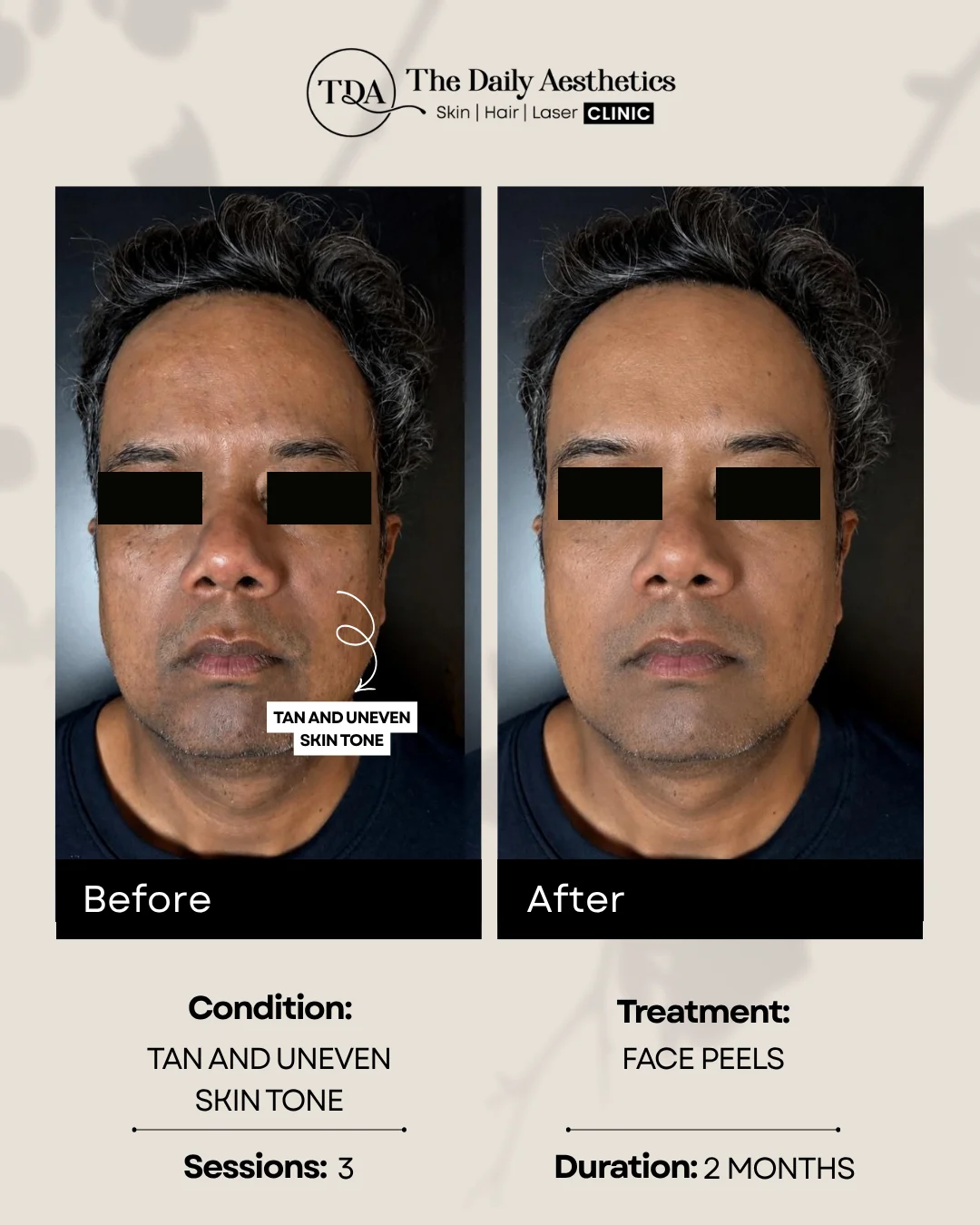 Tan and Uneven Skintone (Face Peels)