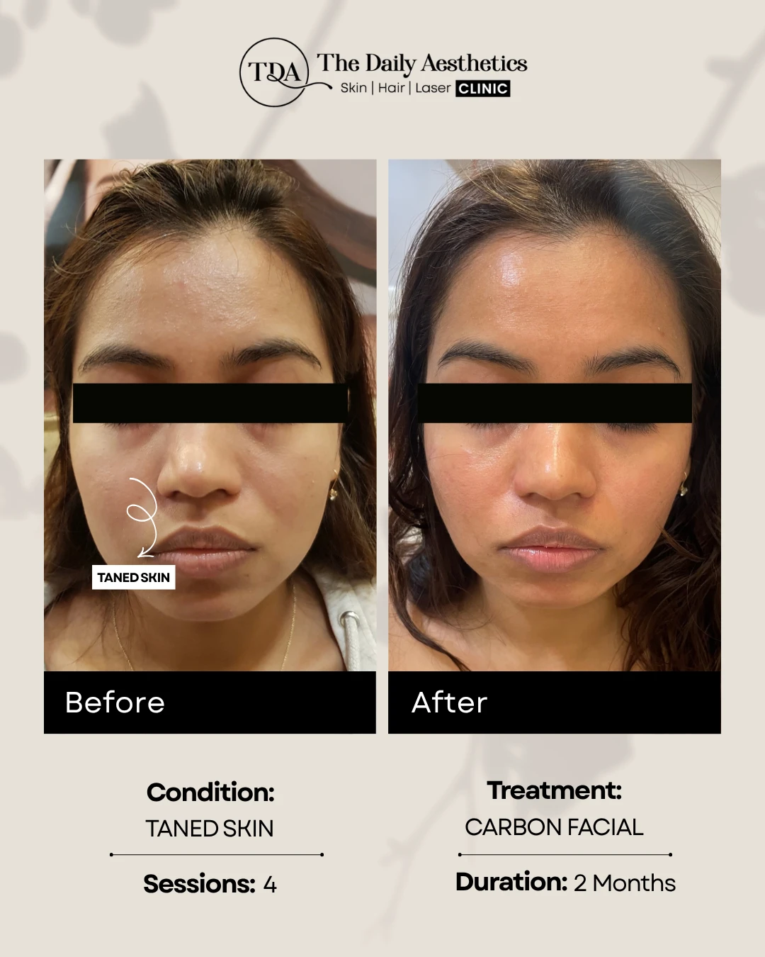 Taned Skin (Carbon Facial Treatment) (2)