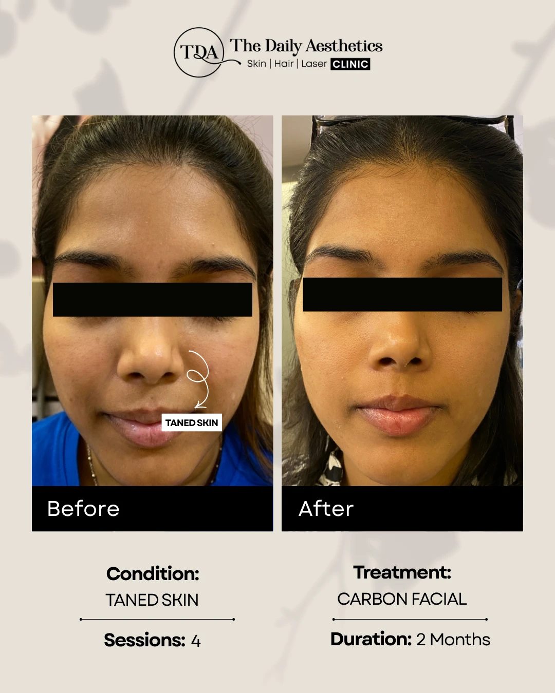 Taned Skin (Carbon Facial Treatment)