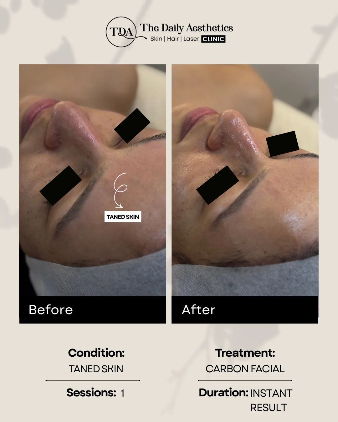 Taned Skin (Carbon Facial)
