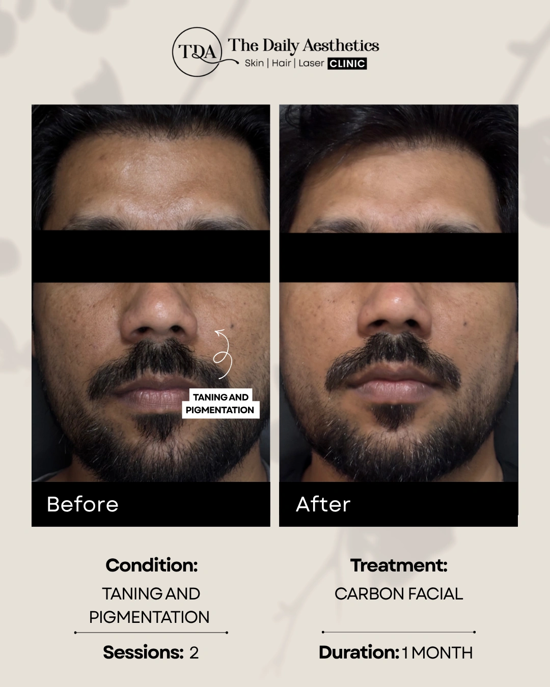 Taning And Pigmentation (Carbon Facial Treatment)