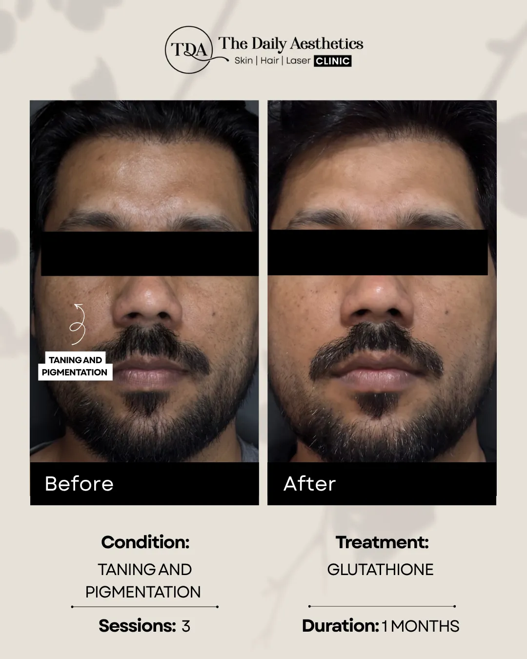 Taning And Pigmentation (Glutathione Treatment)