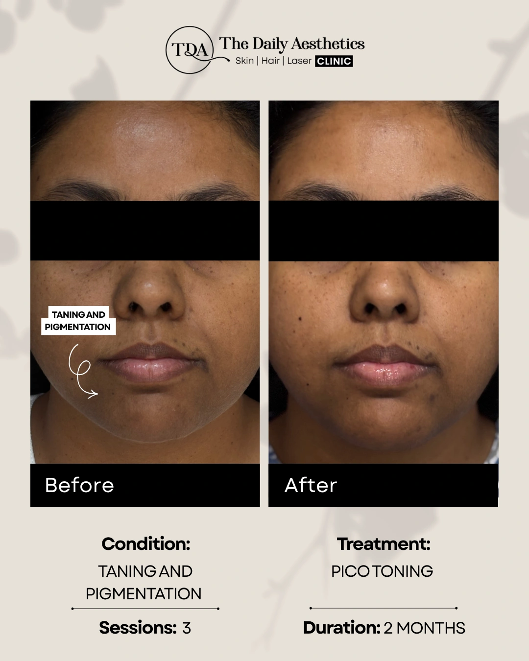 Tanning And Pigmentation (Pico Toning Treatment)