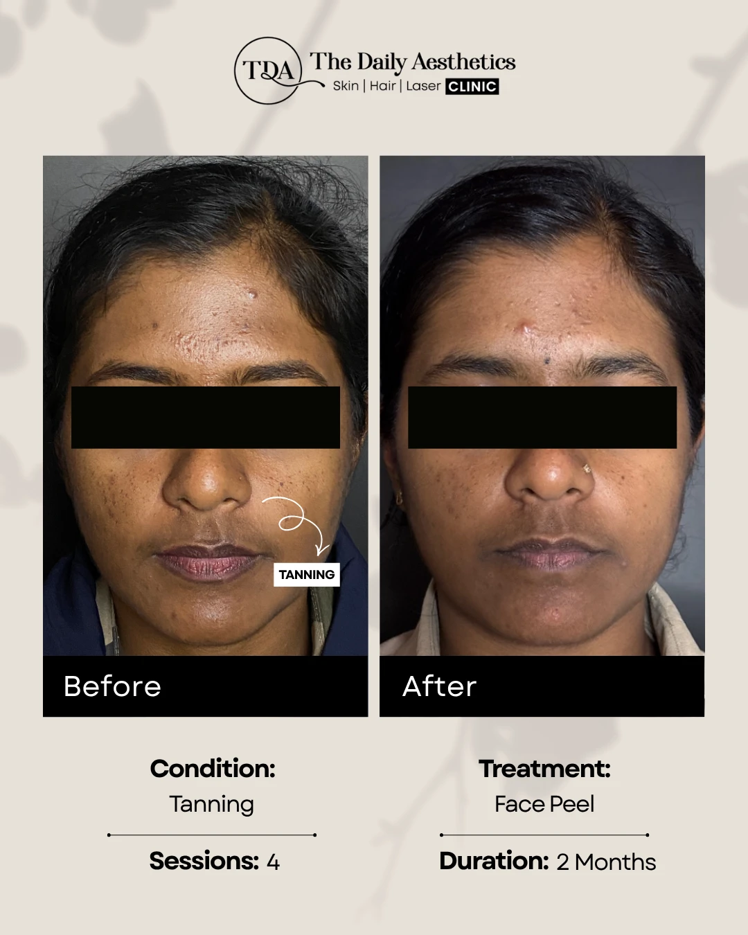 Tanning (Face Peel Treatment)