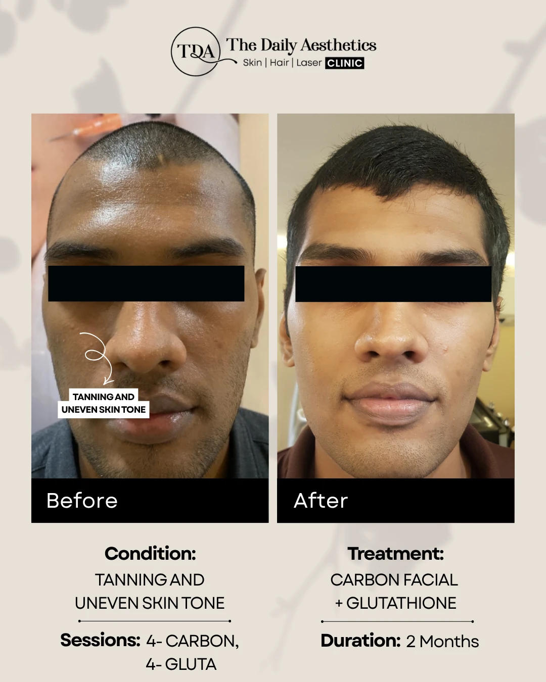 Tanning and Uneven Skintone (Carbon Facial + Glutathione Treatment)