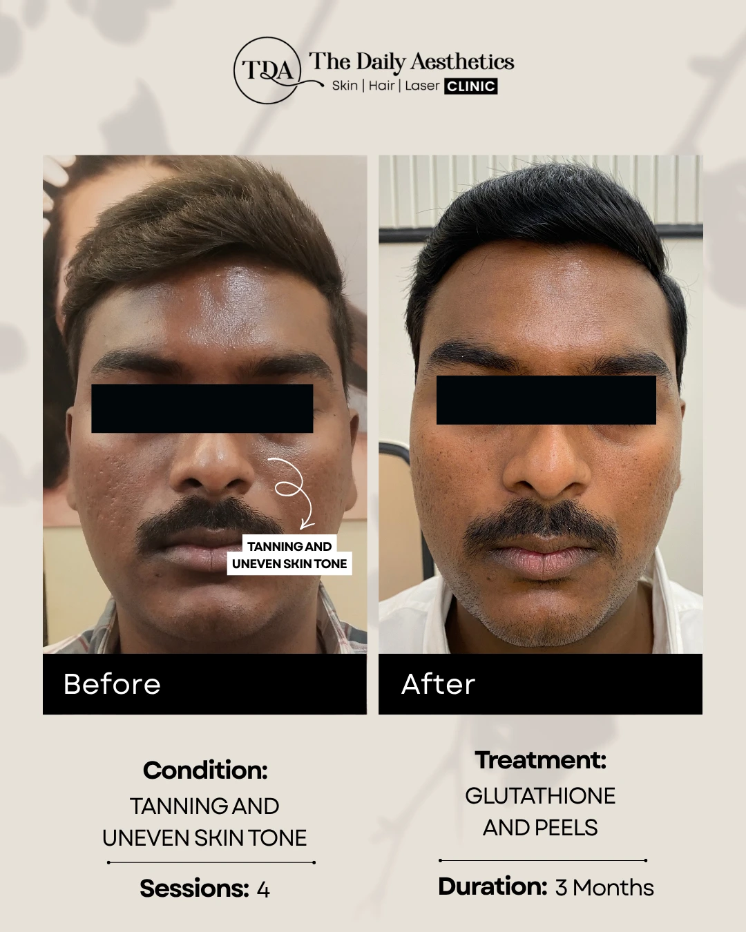 Tanning and Uneven Skintone (Glutathione and Peels Treatment)