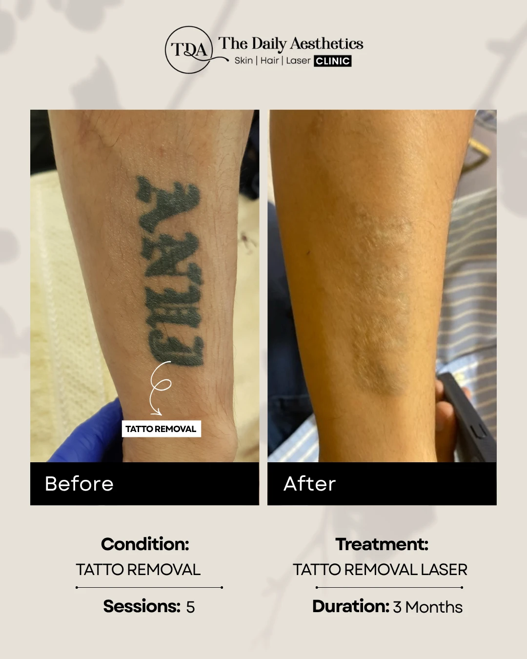 Tatto Removal (Tatto Removal Laser Treatment) (2)