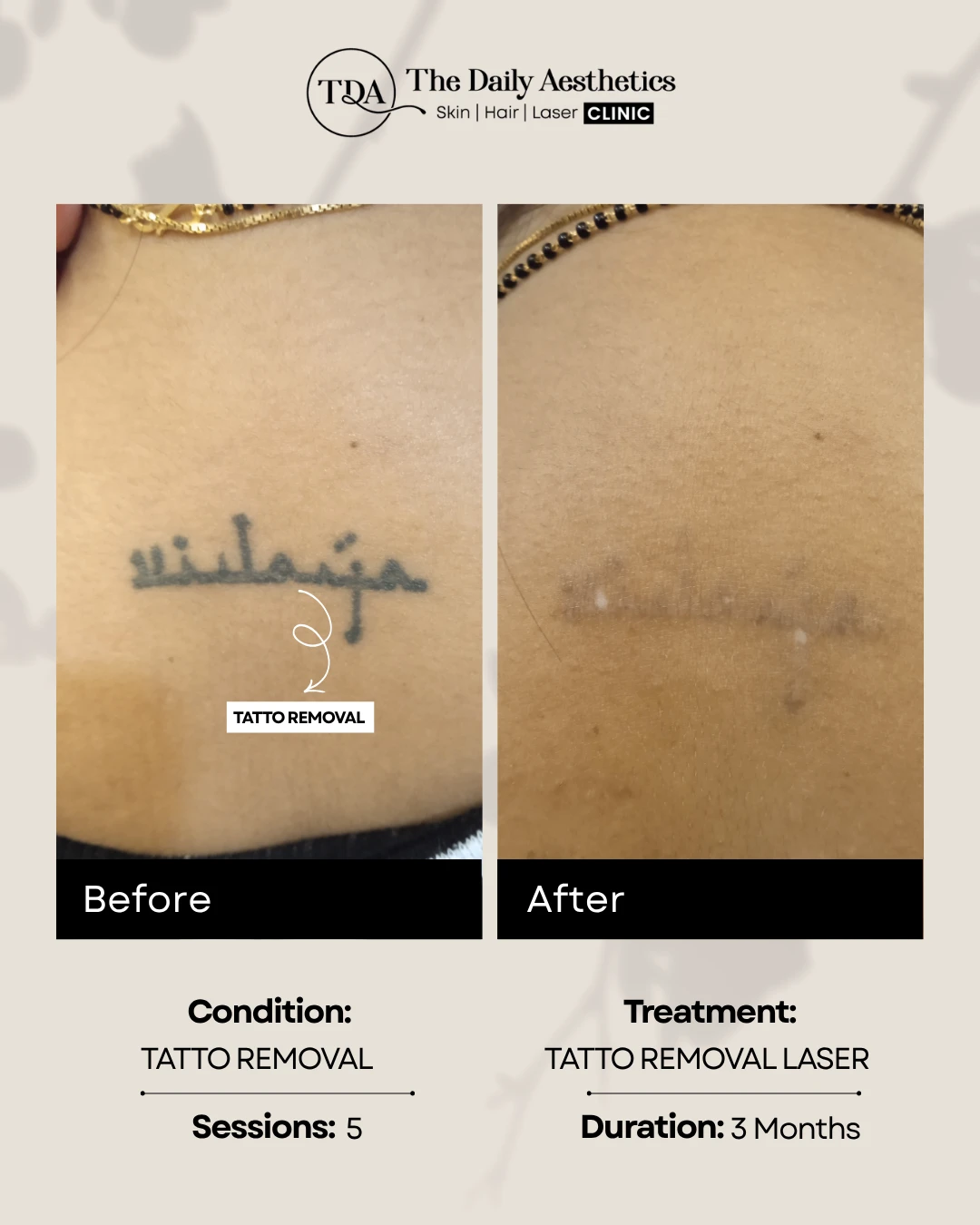 Tatto Removal (Tatto Removal Laser Treatment)
