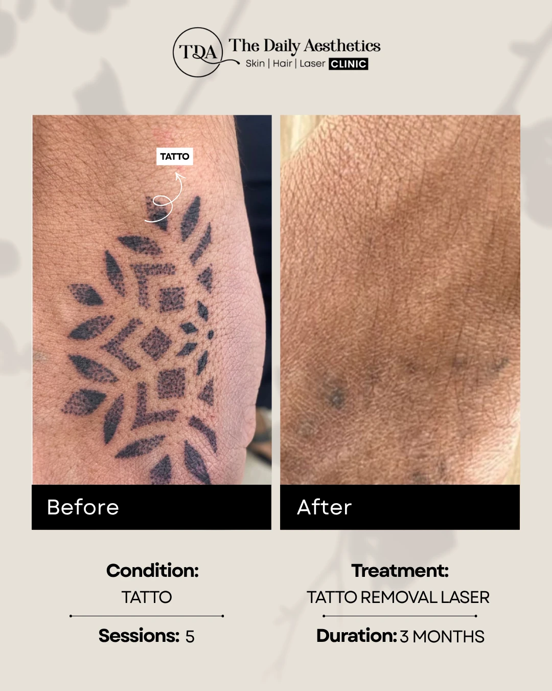 Tatto (Tatto Removal Laser Treatment)