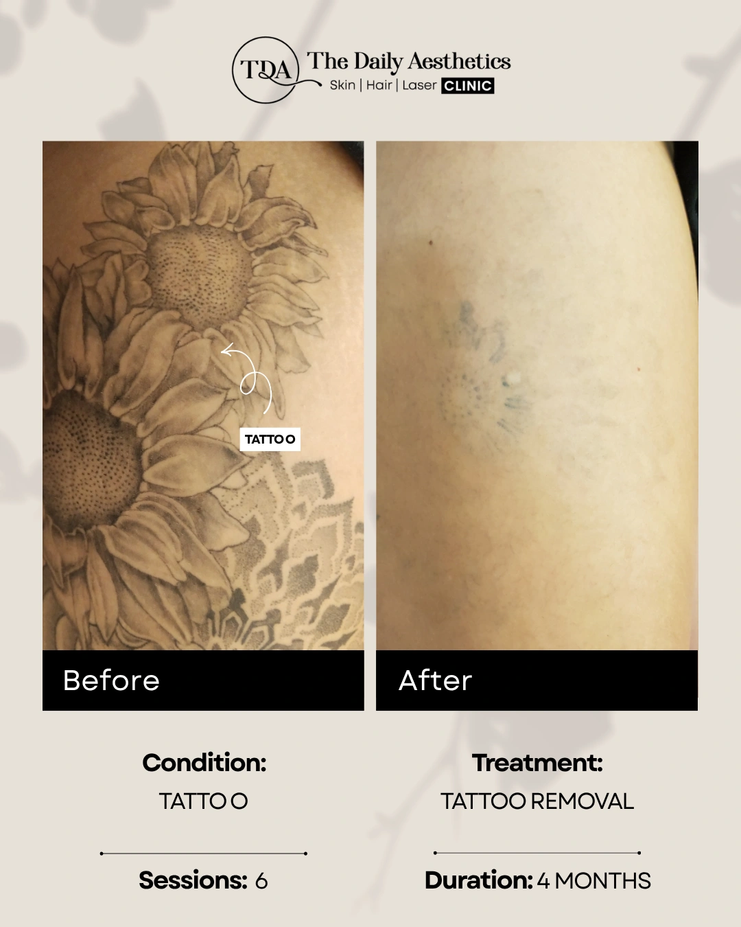 Tattoo (Tattoo Removal Treatment)