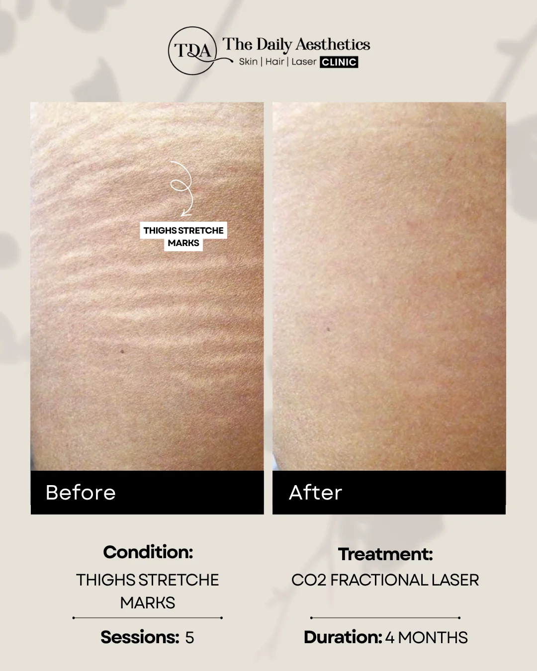 Thighs Stretche Marks (CO2 Fractional Laser)