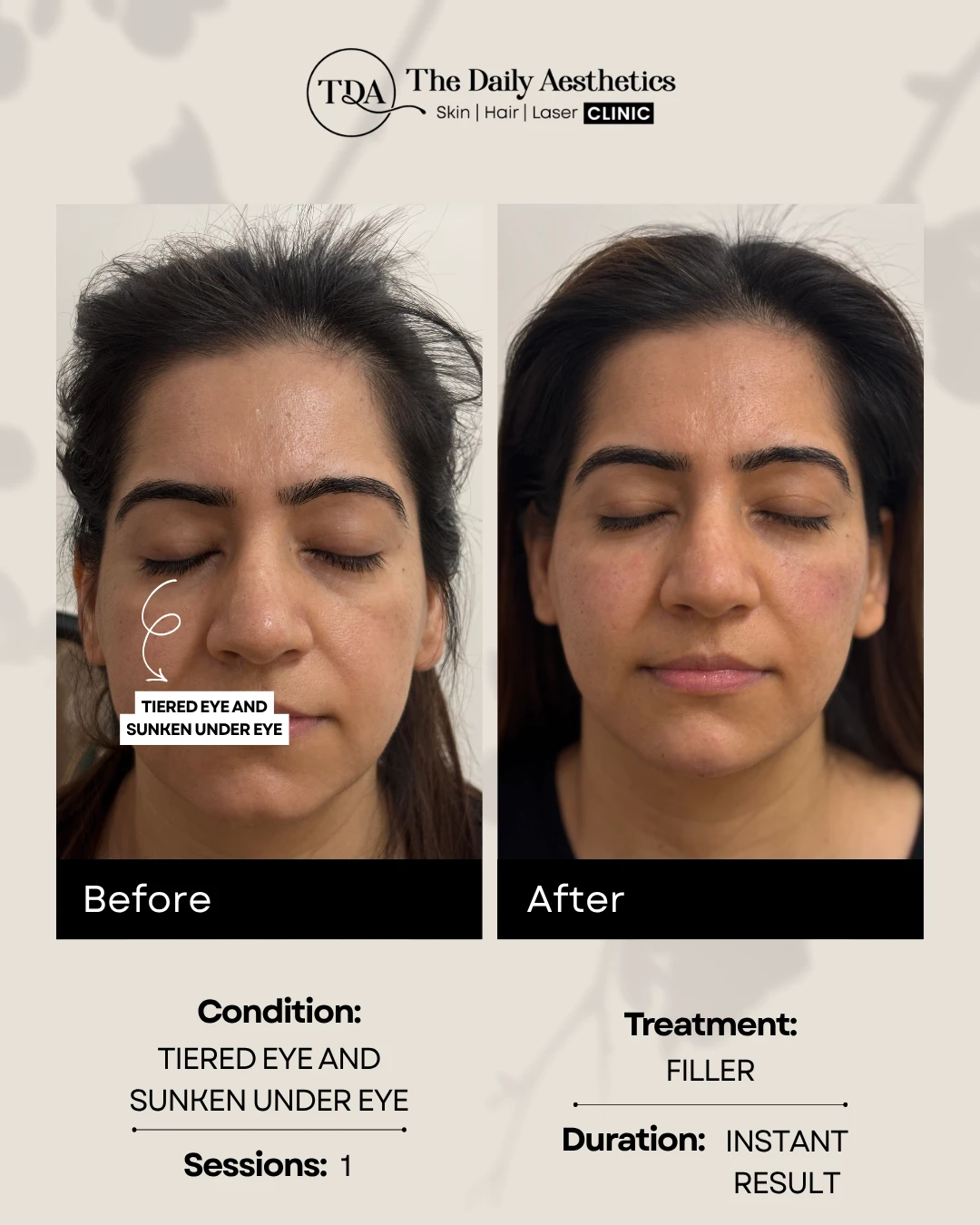 Tiered Eye & Sunken Under Eye (Filler)