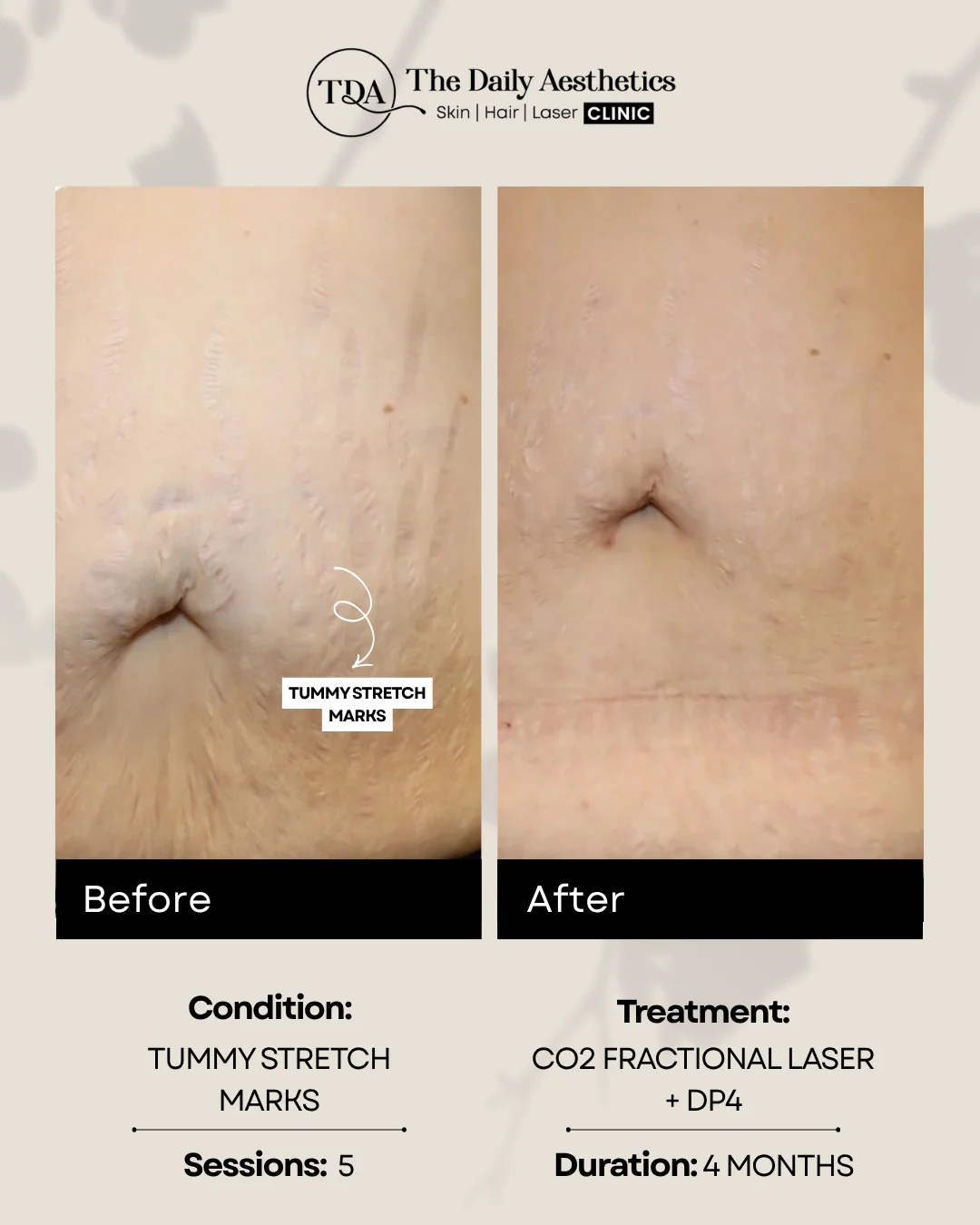 Tummy Stretch Marks (CO2 Fractional Laser + DP4)
