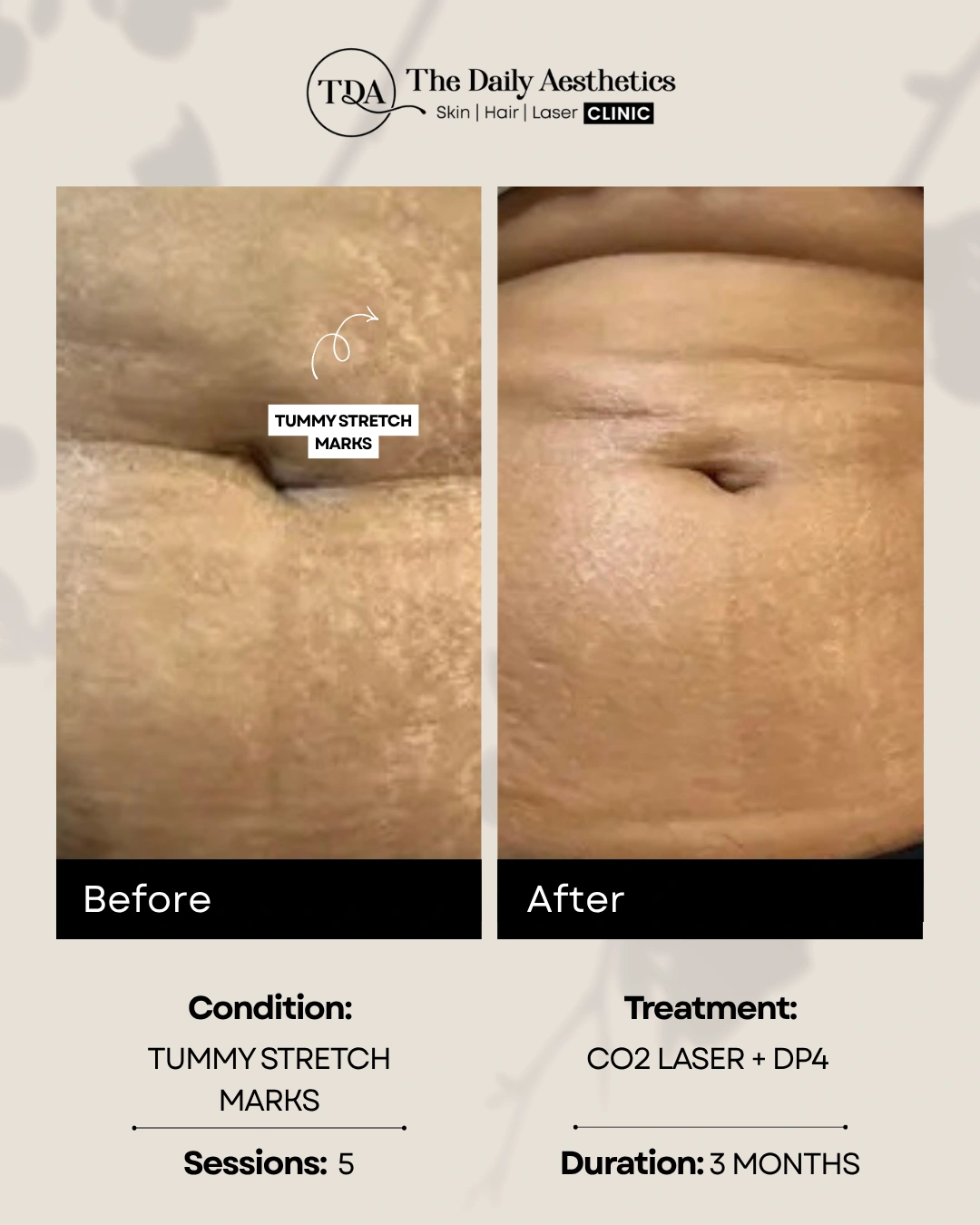 Tummy Stretch Marks (CO2 Laser + DP4 Treatment)
