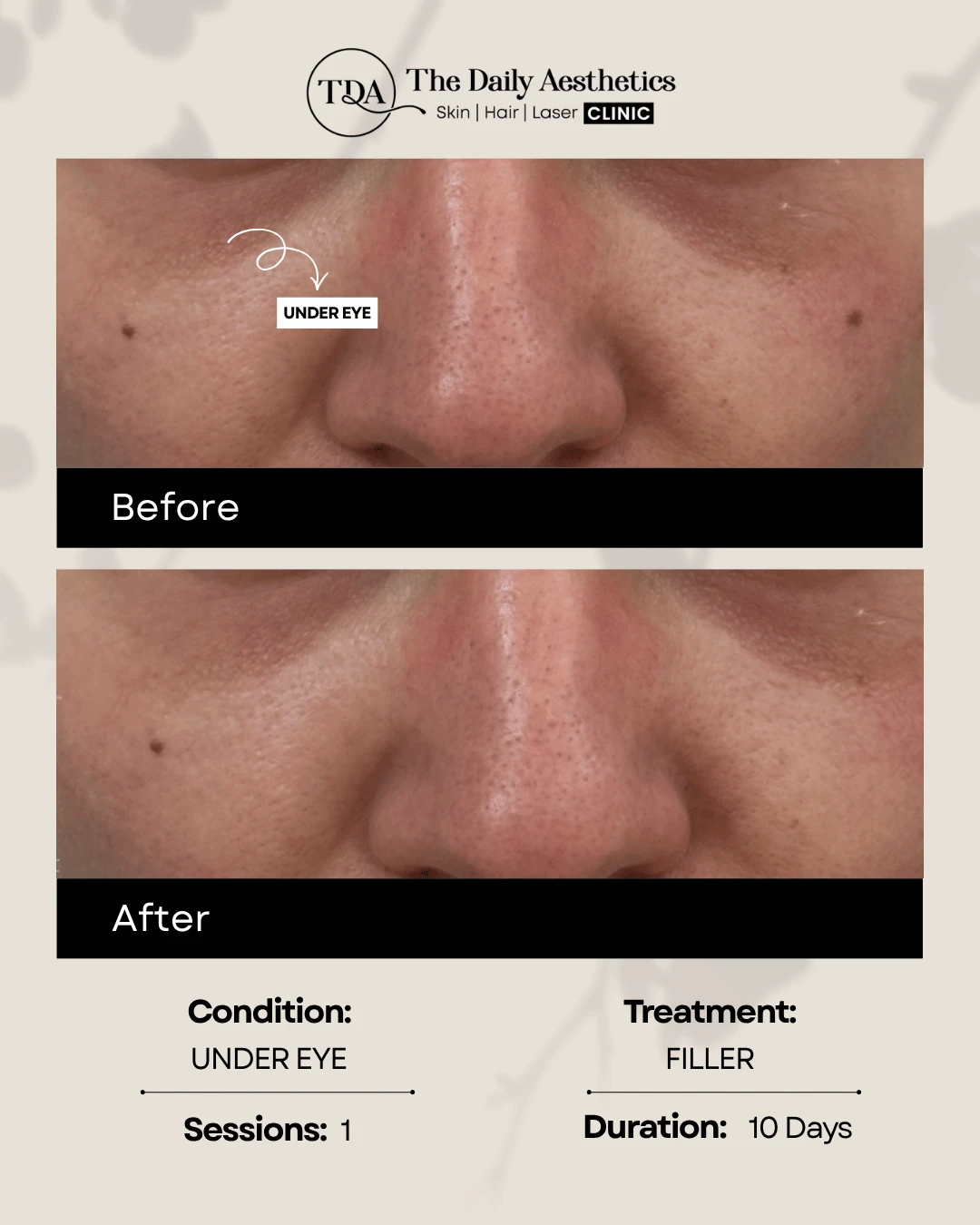 Under Eye (Filler)