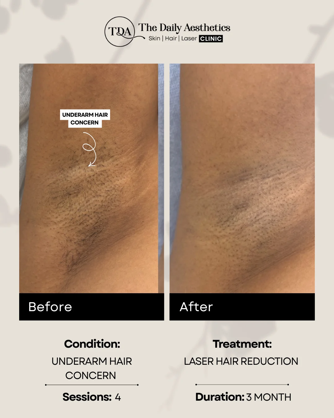 Underarm Hair Concern (Laser Hair Reducation Treatment)