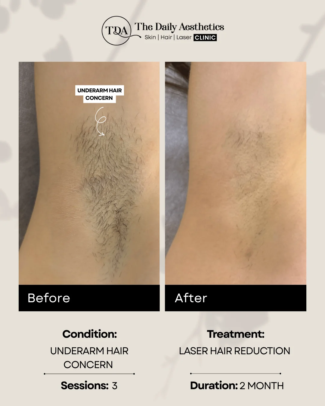 Underarm Hair Concern (Laser Hair Reducation Treatment) 2