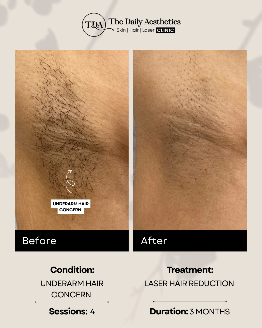 Underarm Hair Concern (Laser Hair Reducation Treatment)
