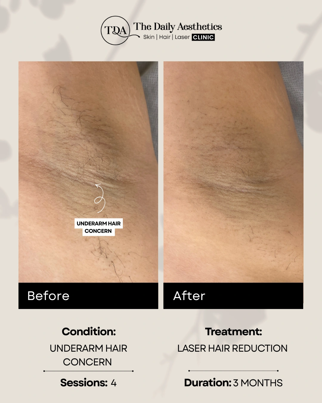 Underarm Hair Concern (Laser Hair Reduction Treatment) (2)